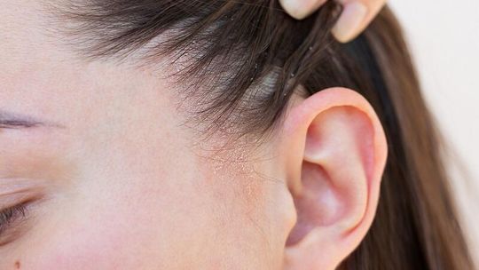 Jakie kosmetyki są bezpieczne przy łuszczycy głowy?